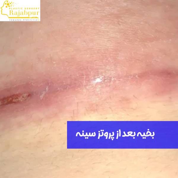 بخیه پروتز سینه