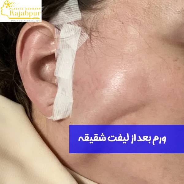 Swelling after a temple lift