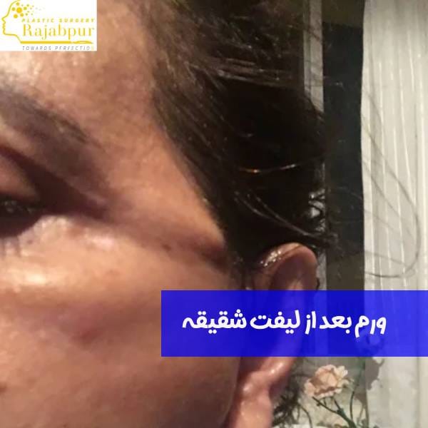 ورم صورت بعد از لیفت شقیقه
