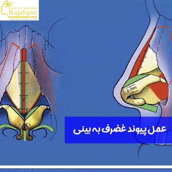 جراحی پیوند غضروف به بینی