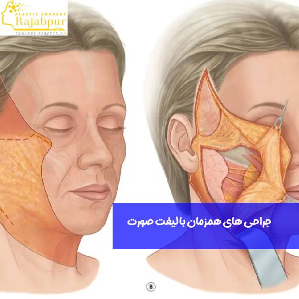 عمل های همزمان با لیفت صورت