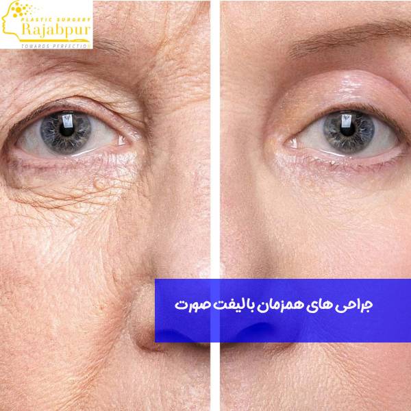 جراحی های همزمان با لیفت صورت
