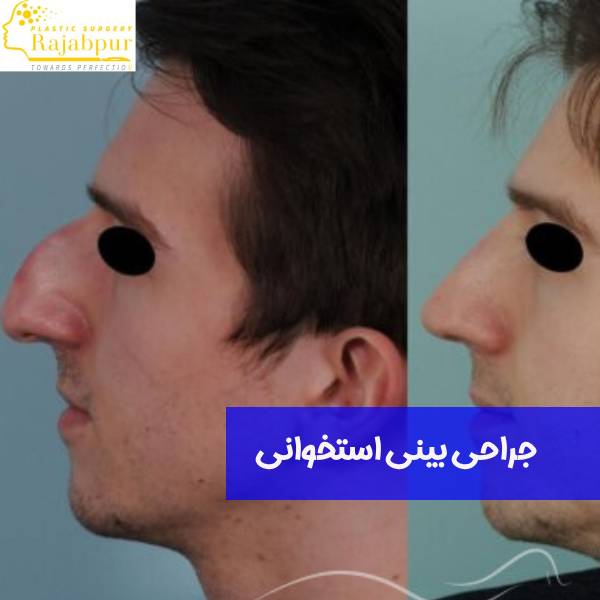 جراحی بینی استخوانی