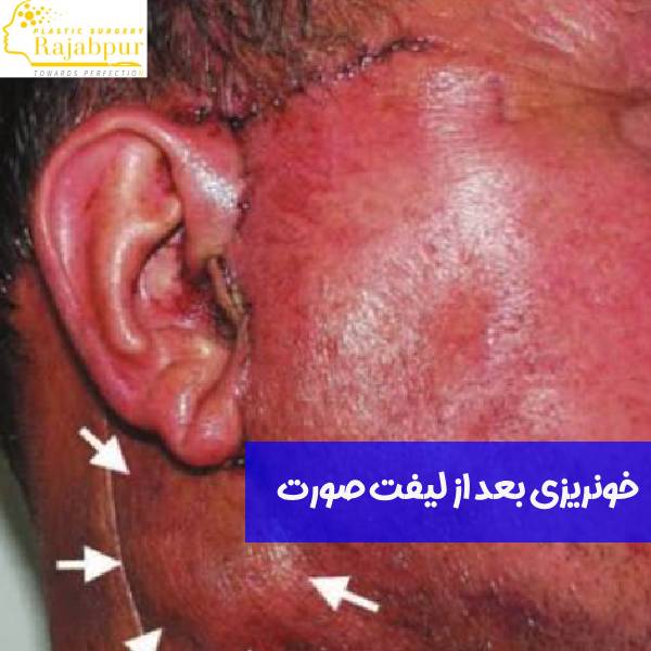 خونریزی بعد از لیفت صورت