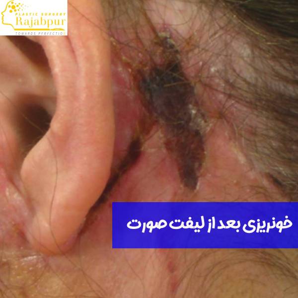 خونریزی بعد از لیفت صورت