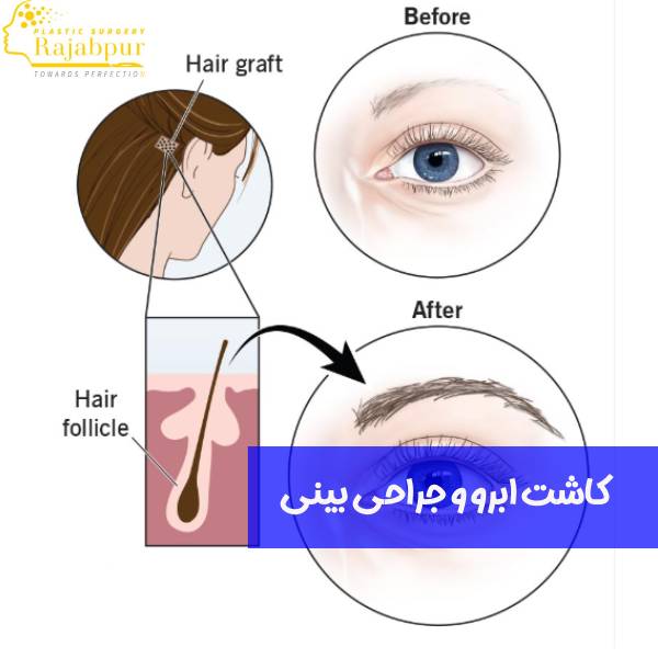 کاشت ابرو و جراحی بینی