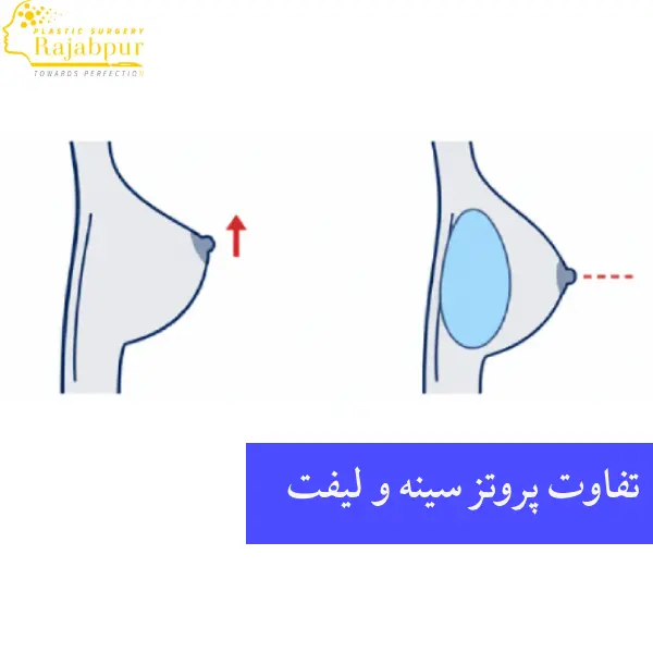 تفاوت پروتز سینه و لیفت سینه